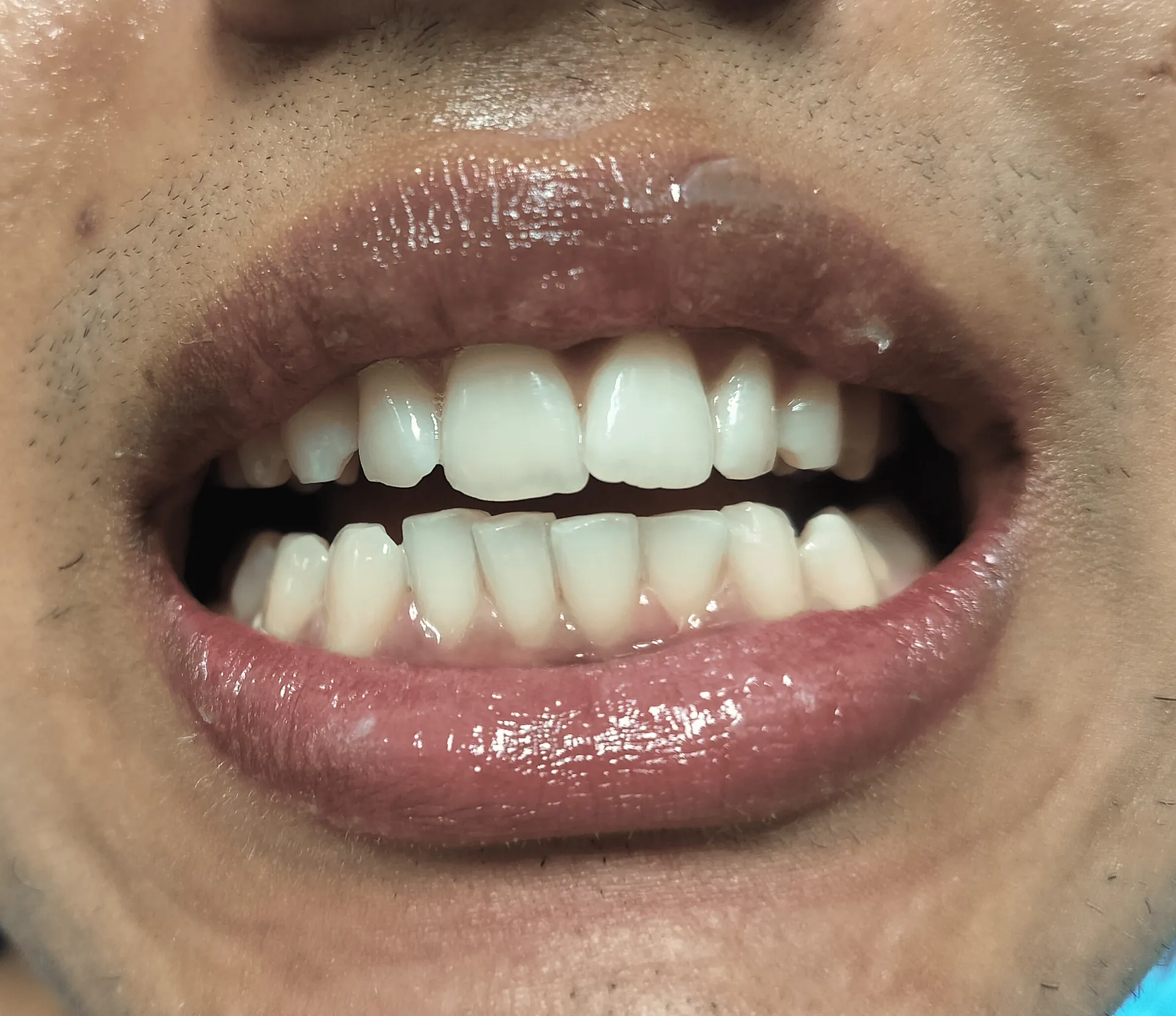 After Treatment