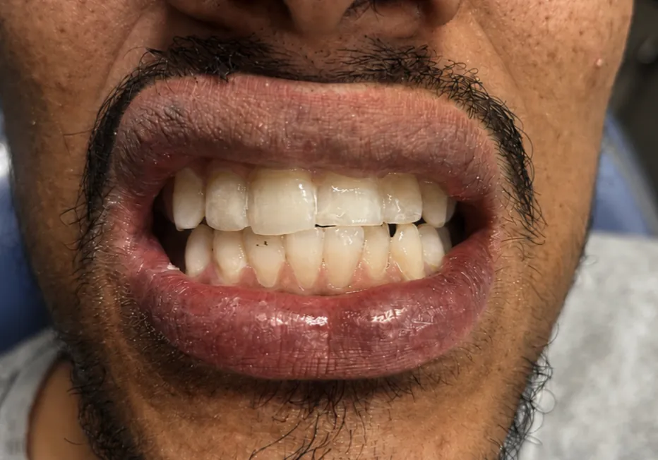 After Treatment