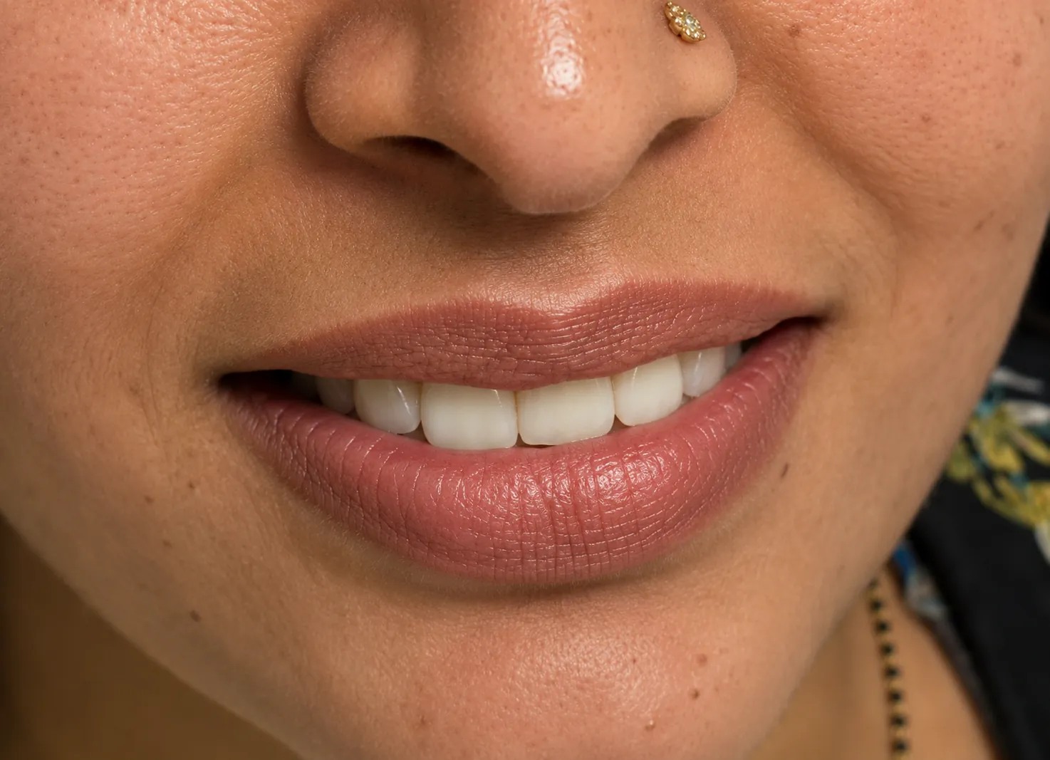 After Treatment
