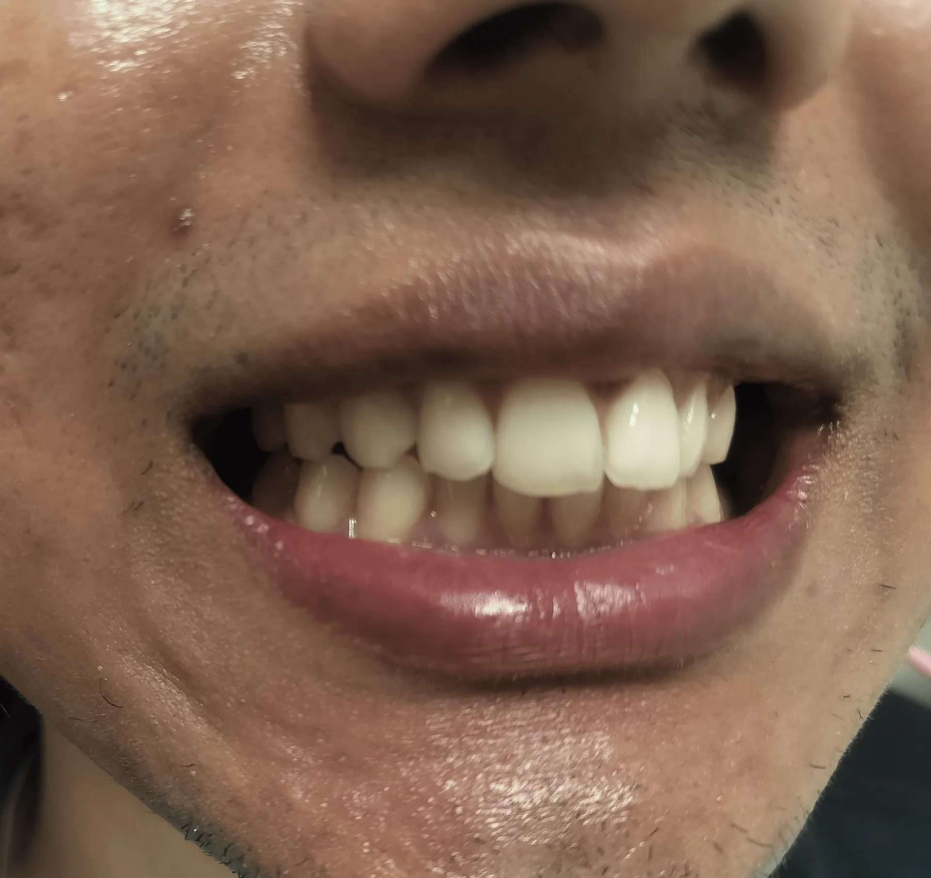 Before Treatment