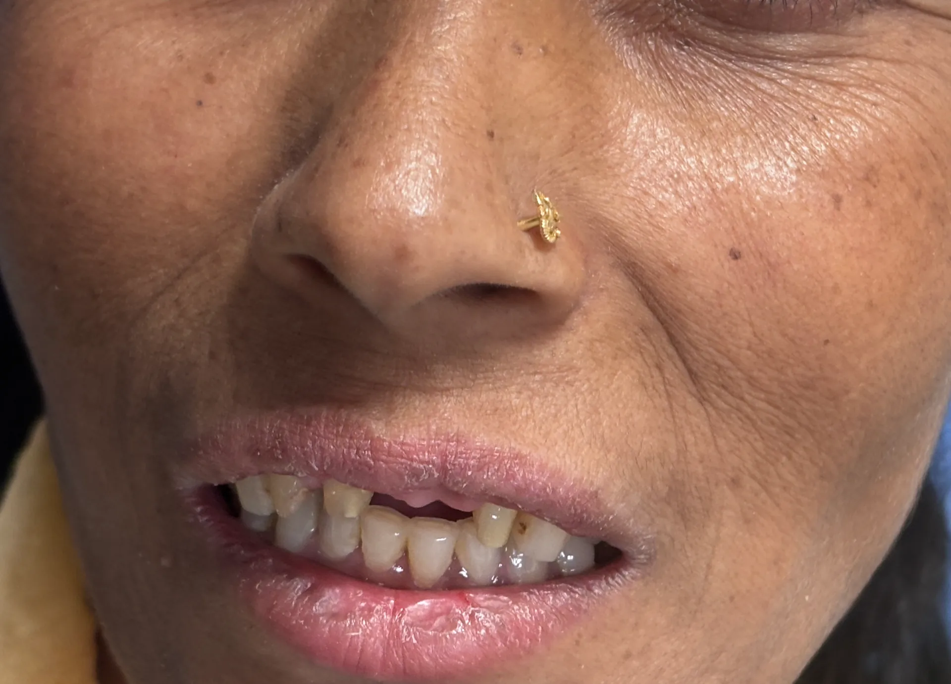 Before Treatment