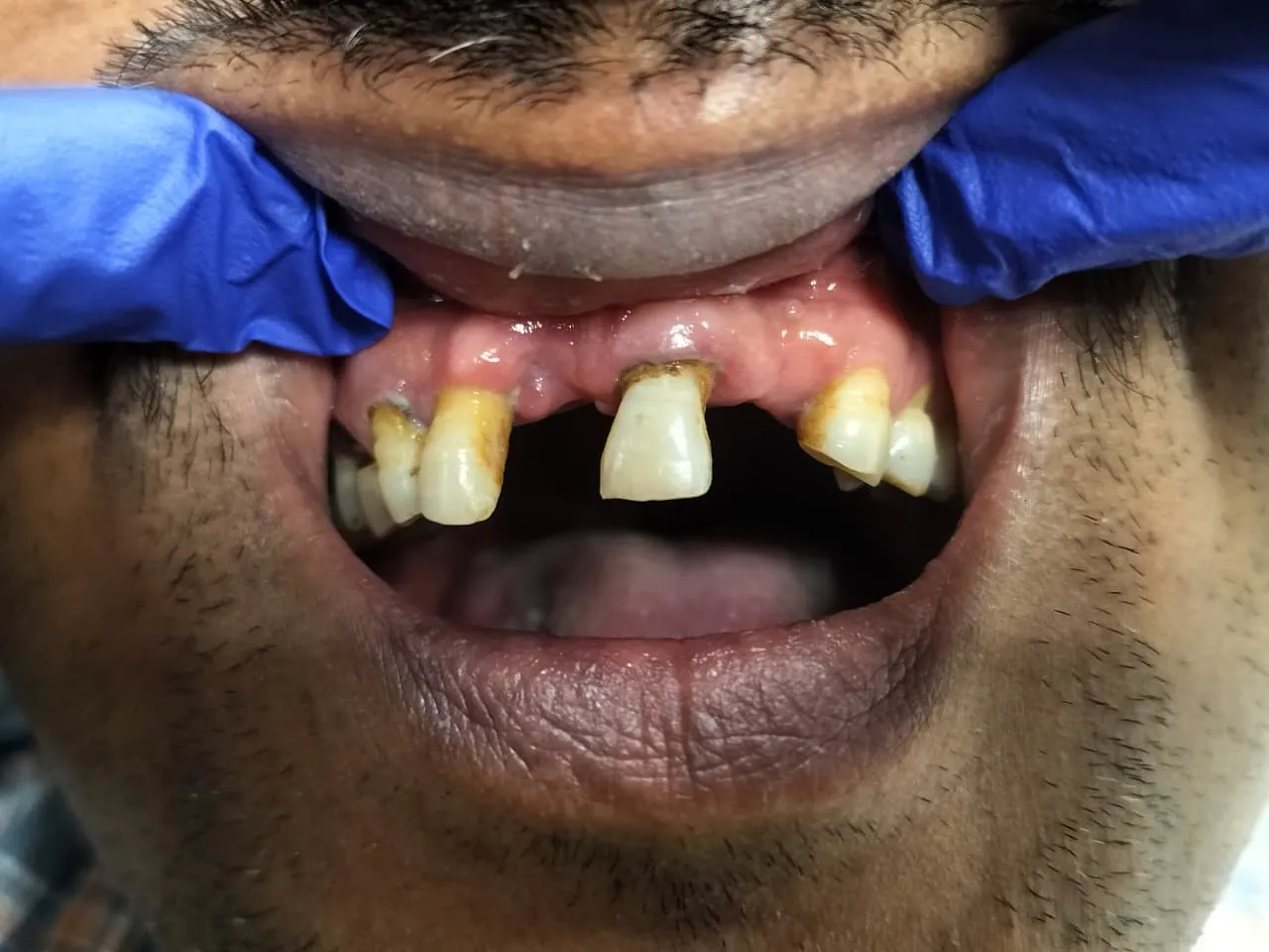 Before Treatment